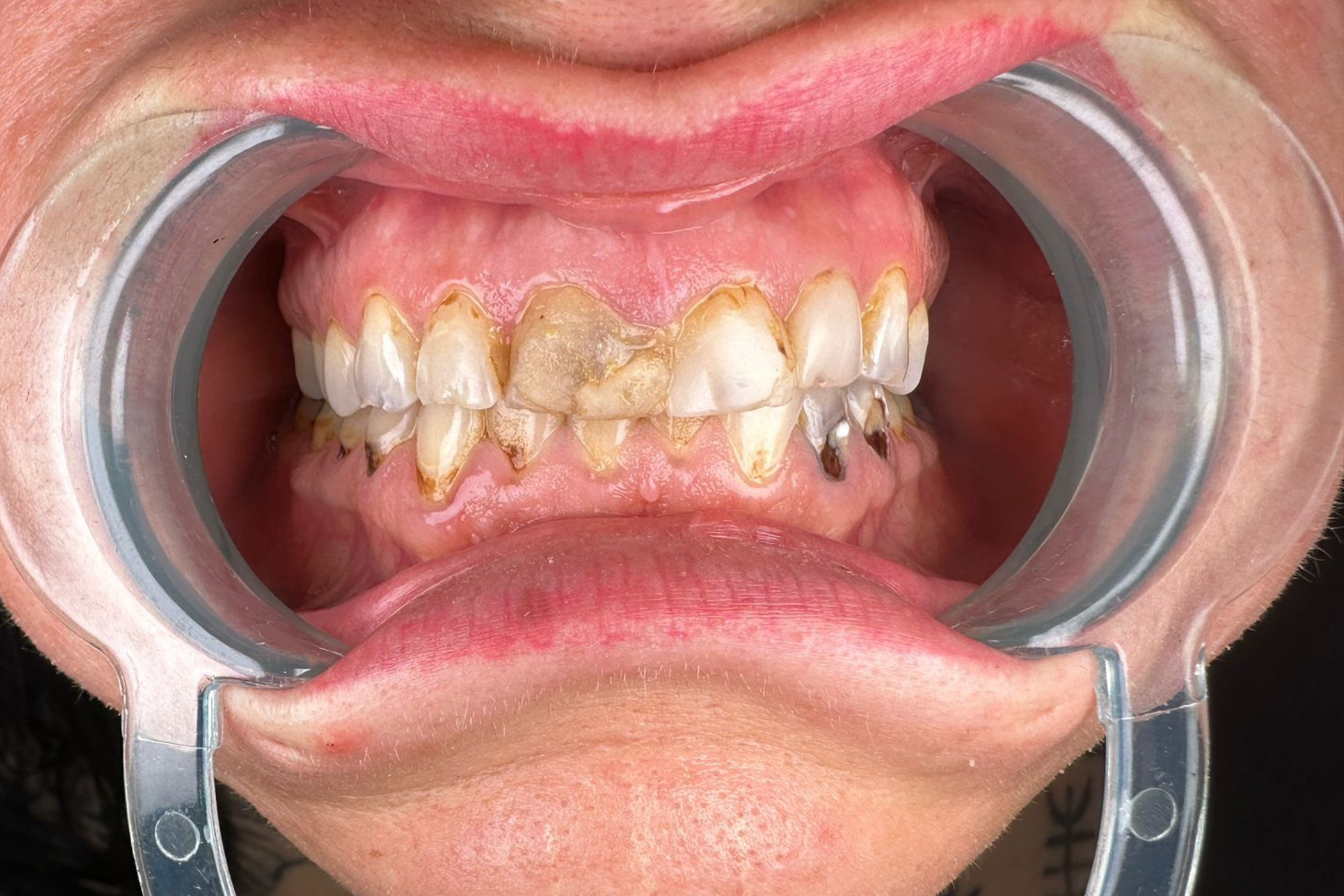 Before Zirconia Crown Treatment